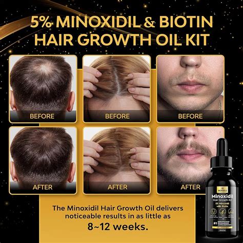 where to buy minoxidil.